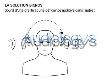 Appareil auditif systeme cros bi cros Phonak sans fil wifi