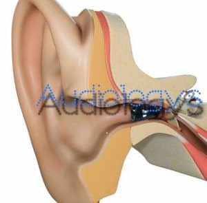 prothèse auditive invisible bluetooth starkey dissimulée au fond du conduit auditif